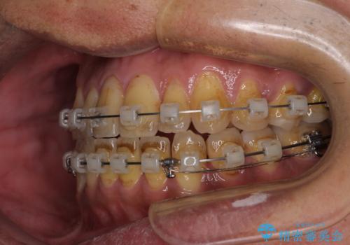 前歯のクロスバイトを改善　ワイヤー装置での非抜歯矯正の治療中