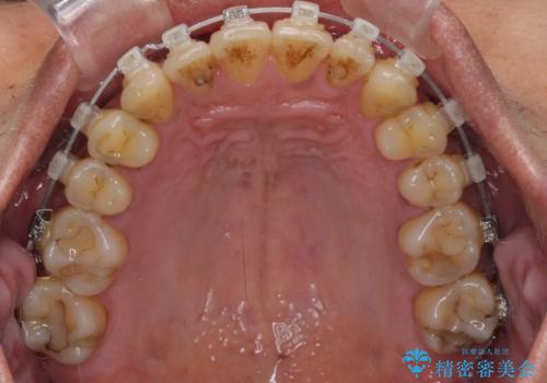 前歯のクロスバイトを改善 ワイヤー装置での非抜歯矯正の治療中