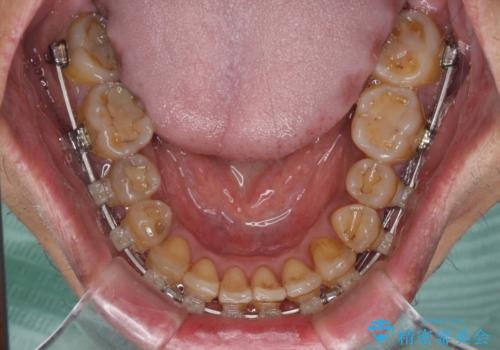 前歯のクロスバイトを改善 ワイヤー装置での非抜歯矯正の治療中