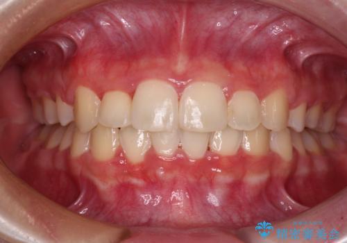 インビザラインが続けられない　ワイヤー矯正での抜歯矯正　その2の症例 治療後