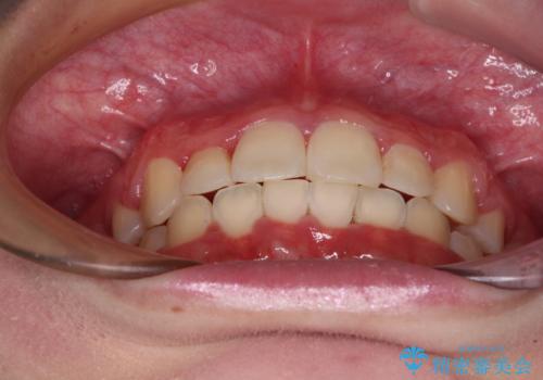 インビザラインが続けられない ワイヤー矯正での抜歯矯正 その2の治療後