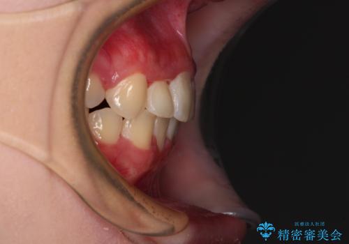 インビザラインが続けられない ワイヤー矯正での抜歯矯正 その2の治療後