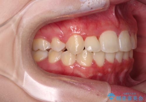 インビザラインが続けられない ワイヤー矯正での抜歯矯正 その2の治療後