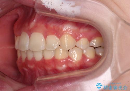 インビザラインが続けられない　ワイヤー矯正での抜歯矯正　その2の治療後