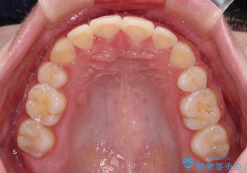 インビザラインが続けられない ワイヤー矯正での抜歯矯正 その2の治療後