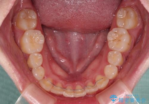 インビザラインが続けられない ワイヤー矯正での抜歯矯正 その2の治療後