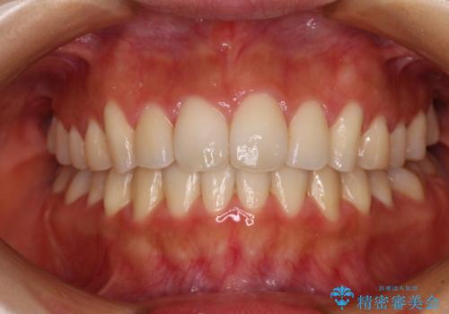 カリエールディスタライザーを併用した、咬み合わせ改善のインビザライン矯正の症例 治療後