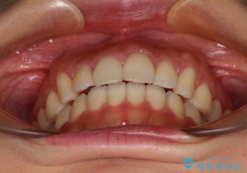 カリエールディスタライザーを併用した、咬み合わせ改善のインビザライン矯正の治療後