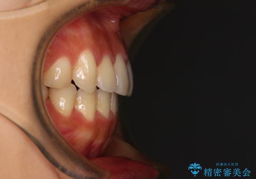 カリエールディスタライザーを併用した、咬み合わせ改善のインビザライン矯正の治療後