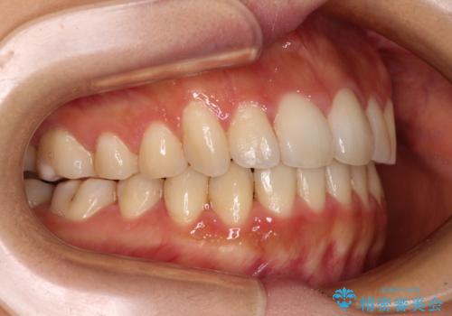 カリエールディスタライザーを併用した、咬み合わせ改善のインビザライン矯正の治療後