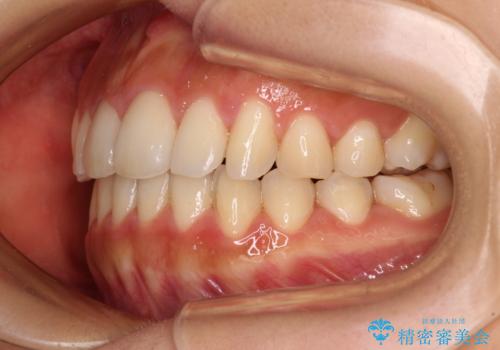 カリエールディスタライザーを併用した、咬み合わせ改善のインビザライン矯正の治療後
