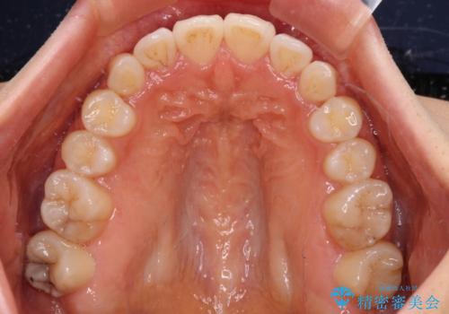 カリエールディスタライザーを併用した、咬み合わせ改善のインビザライン矯正の治療後