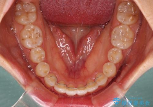 カリエールディスタライザーを併用した、咬み合わせ改善のインビザライン矯正の治療後