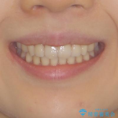 カリエールディスタライザーを併用した、咬み合わせ改善のインビザライン矯正の治療後(顔貌)