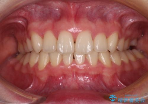 上顎のみの抜歯矯正　前歯のデコボコを改善するの症例 治療後