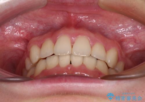 上顎のみの抜歯矯正 前歯のデコボコを改善するの治療後