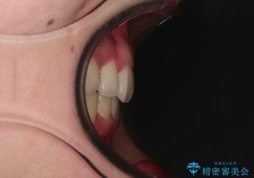 上顎のみの抜歯矯正 前歯のデコボコを改善するの治療後