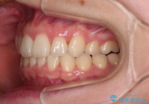 上顎のみの抜歯矯正　前歯のデコボコを改善するの治療後