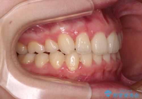 上顎のみの抜歯矯正 前歯のデコボコを改善するの治療後
