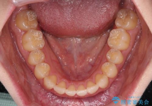 上顎のみの抜歯矯正　前歯のデコボコを改善するの治療後
