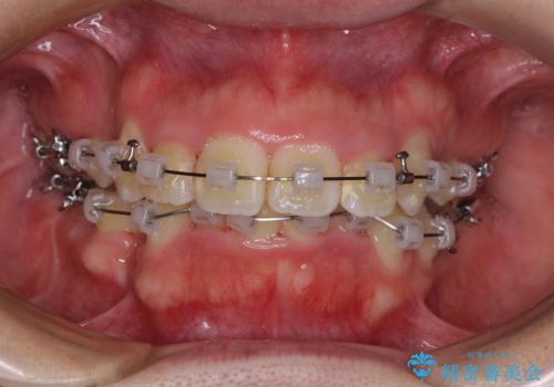【モニター】八重歯を抜歯矯正でスッキリした口元にの治療中
