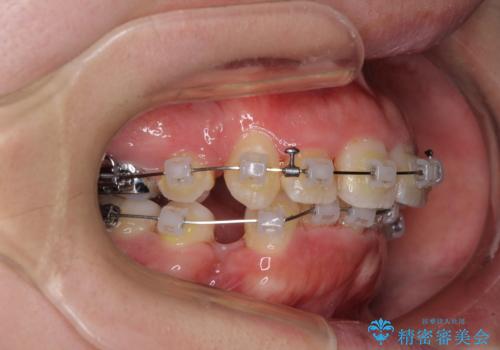 【モニター】八重歯を抜歯矯正でスッキリした口元にの治療中