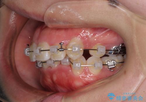 【モニター】八重歯を抜歯矯正でスッキリした口元にの治療中