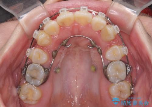 【モニター】八重歯を抜歯矯正でスッキリした口元にの治療中
