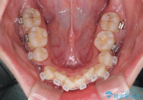 【モニター】八重歯を抜歯矯正でスッキリした口元にの治療中