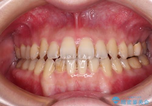 オープンバイトと前歯のデコボコをインビザライン矯正で解消の治療中