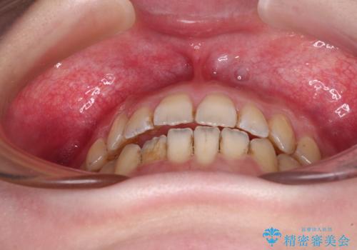 オープンバイトと前歯のデコボコをインビザライン矯正で解消の治療中