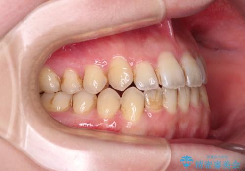 オープンバイトと前歯のデコボコをインビザライン矯正で解消の治療中