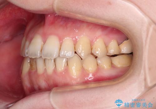 オープンバイトと前歯のデコボコをインビザライン矯正で解消の治療中