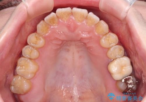 オープンバイトと前歯のデコボコをインビザライン矯正で解消の治療中