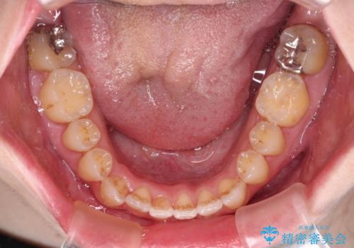 オープンバイトと前歯のデコボコをインビザライン矯正で解消の治療中