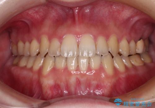 オープンバイトと前歯のデコボコをインビザライン矯正で解消の症例 治療後