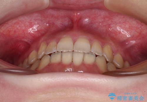 オープンバイトと前歯のデコボコをインビザライン矯正で解消の治療後