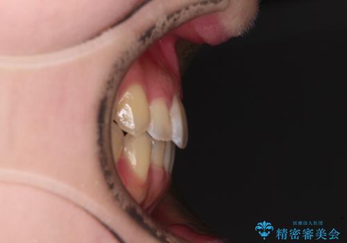 オープンバイトと前歯のデコボコをインビザライン矯正で解消の治療後