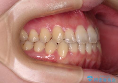 オープンバイトと前歯のデコボコをインビザライン矯正で解消の治療後