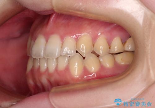オープンバイトと前歯のデコボコをインビザライン矯正で解消の治療後