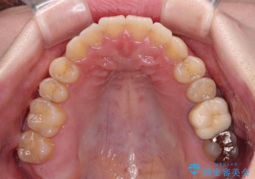 オープンバイトと前歯のデコボコをインビザライン矯正で解消の治療後