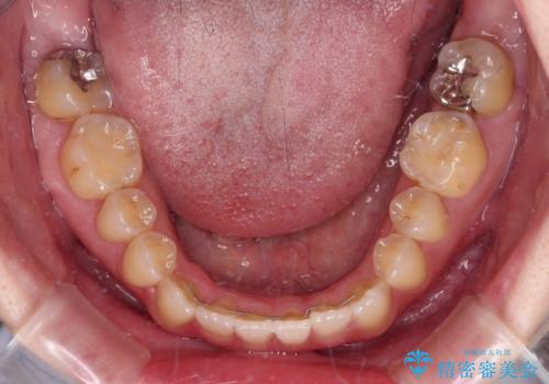 オープンバイトと前歯のデコボコをインビザライン矯正で解消の治療後