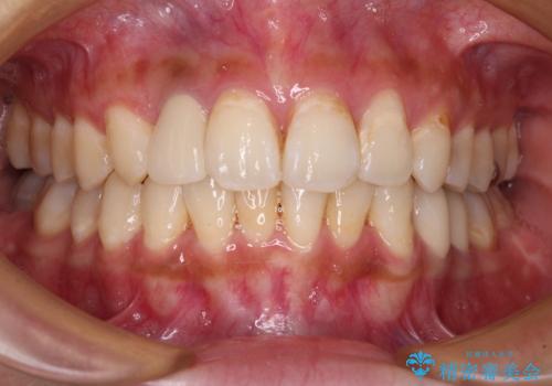 以前治療した前歯をきれいに治したい オールセラミッククラウンの治療後