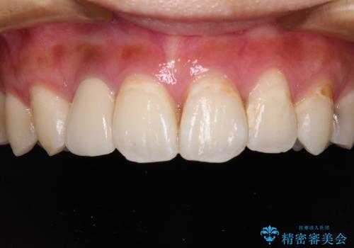 以前治療した前歯をきれいに治したい オールセラミッククラウン