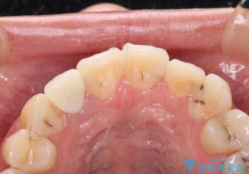 以前治療した前歯をきれいに治したい オールセラミッククラウンの治療後
