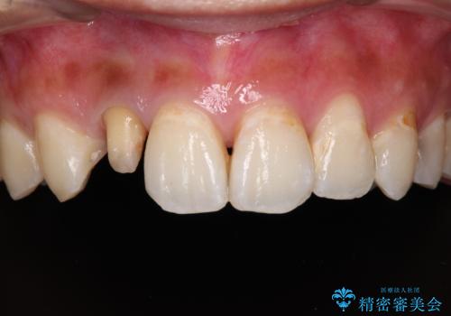 以前治療した前歯をきれいに治したい オールセラミッククラウンの治療中