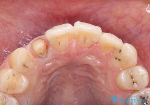 以前治療した前歯をきれいに治したい オールセラミッククラウンの治療中