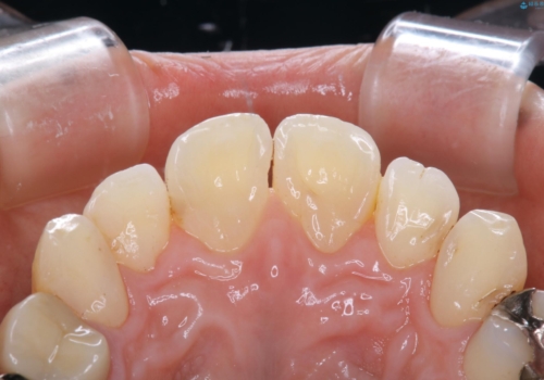 2カ月に1回の着色落とし(PMTC)の治療後