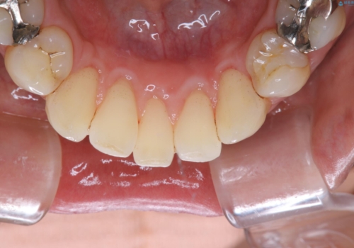 2カ月に1回の着色落とし(PMTC)の治療後
