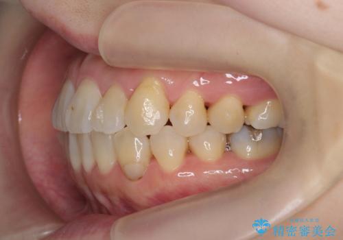 [ マウスピース矯正 ]  出っ歯を改善したいの治療後